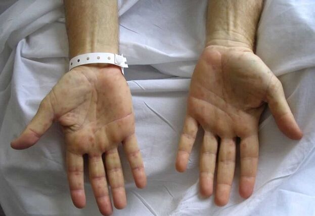 Syphilis on the hands as a cause of pathological discharge from the penis